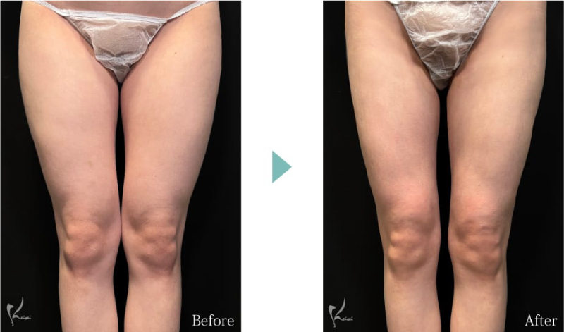 大腿全周のボディジェット脂肪吸引のBeforeとAfter