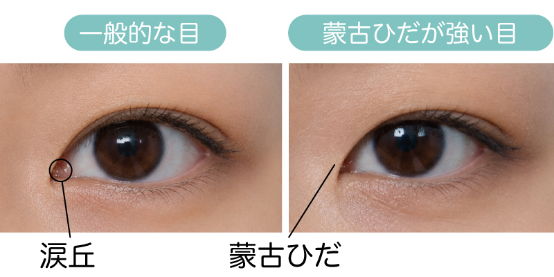 蒙古襞