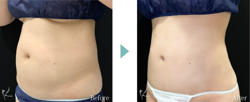 腰の脂肪吸引のBeforeとAfter