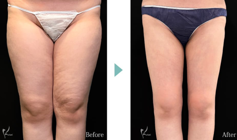 太もも脂肪吸引のBeforeとAfter