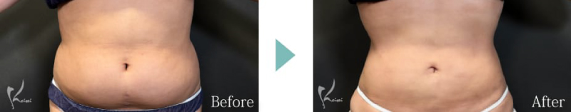 腹部全体+腰 ボディジェット脂肪吸引のBeforeとAfter