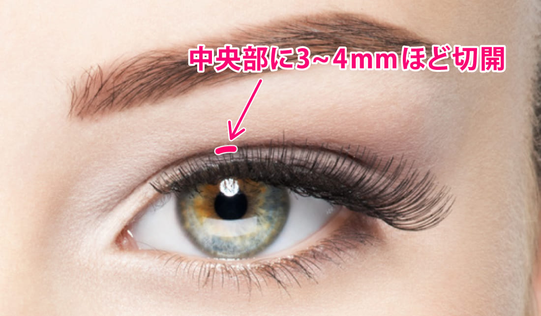 上まぶたの眼窩脂肪を小さな切開部から取り除く二重脱脂法