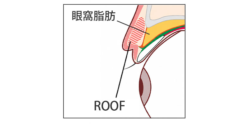 上まぶたの眼窩脂肪とROOFの位置の違い