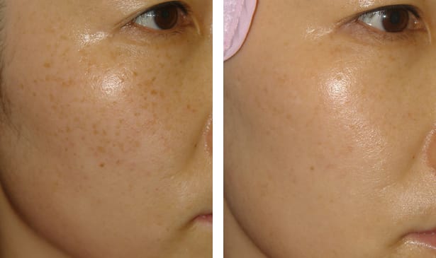 ピコトーニングのBeforeとAfter