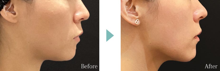 ソフウェーブのBeforeとAfter