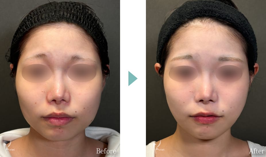 エラ骨切りのBeforeとAfter