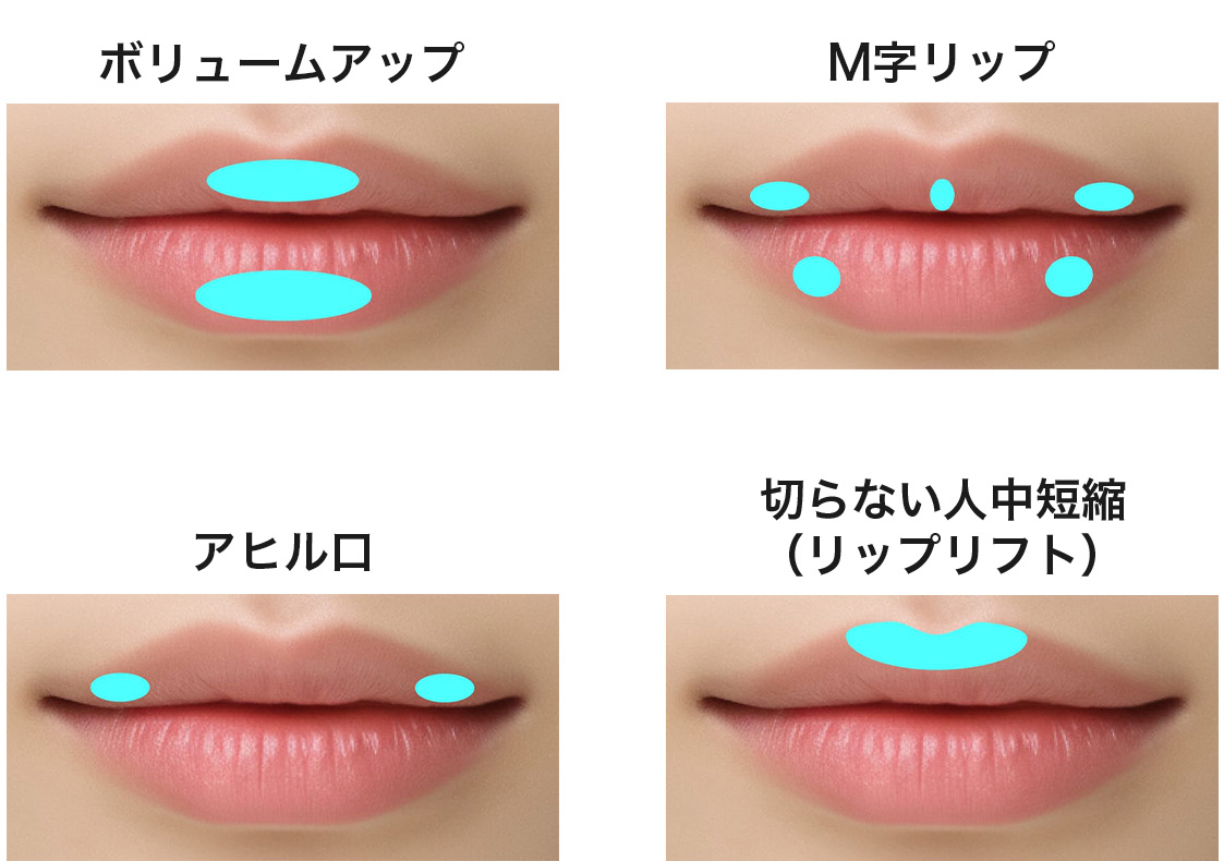 恵聖会クリニックの唇ヒアルロン酸で注入する位置