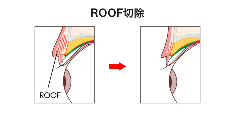 ROOF切除の施術イメージ