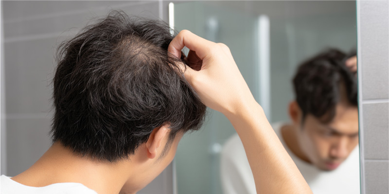 AGA治療の効果を確認する男性の頭髪