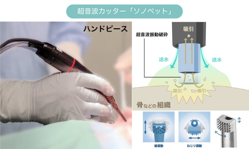 超音波骨切削器（超音波カッター）ソノペットを使用するイメージ