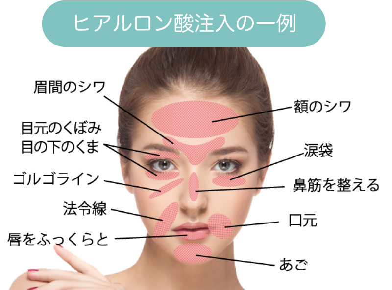 ヒアルロン酸の注入部位