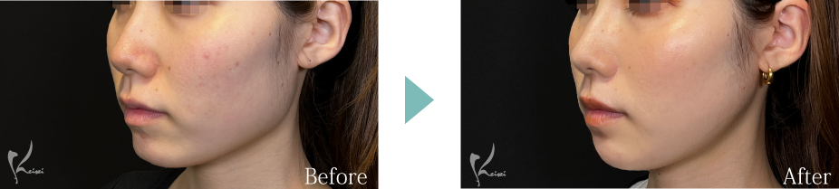 エラ骨切りのBeforeとAfter
