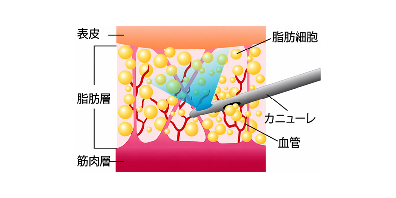 ふくらはぎ脂肪吸引で皮下脂肪を調整する部位のイメージ