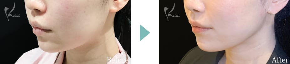ホホアゴの脂肪吸引のBeforeとAfter