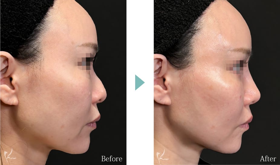 鼻中隔延長のBEFORE・AFTER