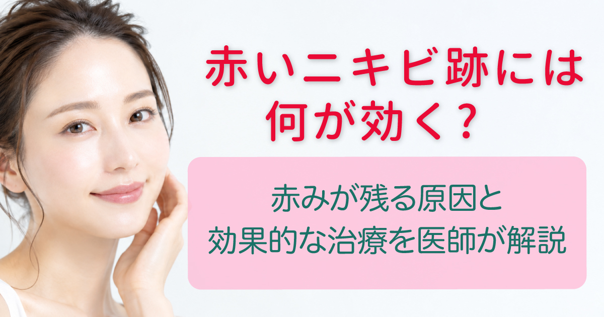 赤いニキビ跡の原因と治療方法を解説するイメージ