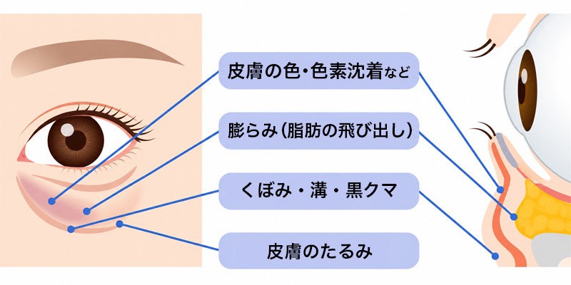 眼窩脂肪の突出と涙溝によって目の下に影ができる仕組み