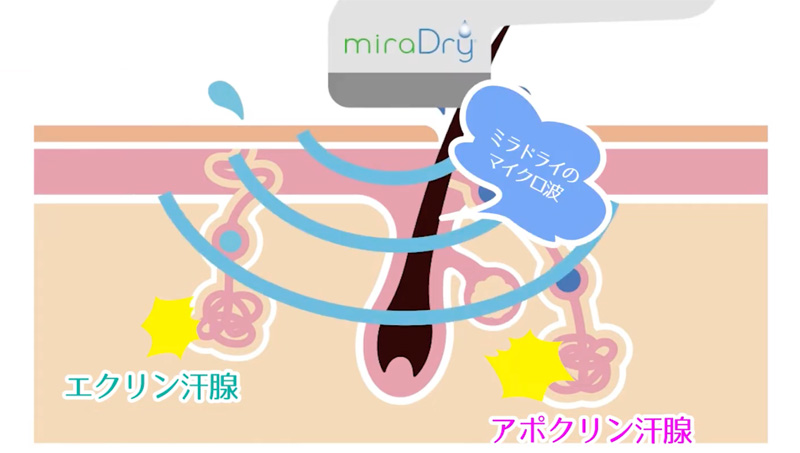 ミラドライのマイクロ波がワキの汗腺へ熱エネルギーを与える仕組み