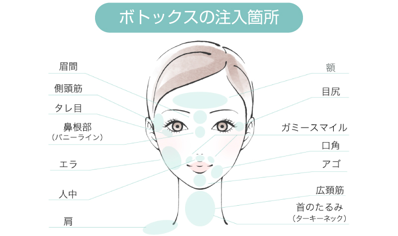 ボトックスの注入箇所