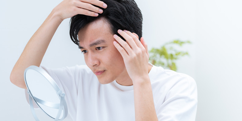 AGAによる生え際や頭頂部の薄毛を示すイメージ