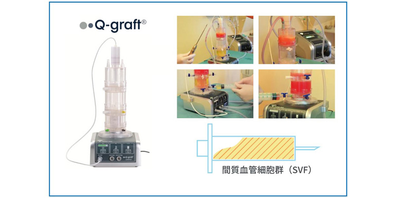 Q-graft&reg;（キューグラフト）のイメージ