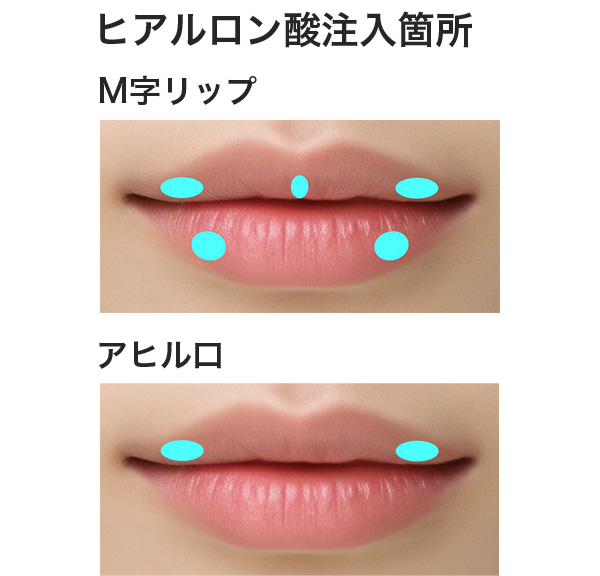M字リップとアヒル口のヒアルロン酸注入箇所の違い