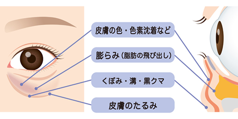眼窩脂肪の突出や目の下のくぼみなど黒クマの原因を示すイメージ