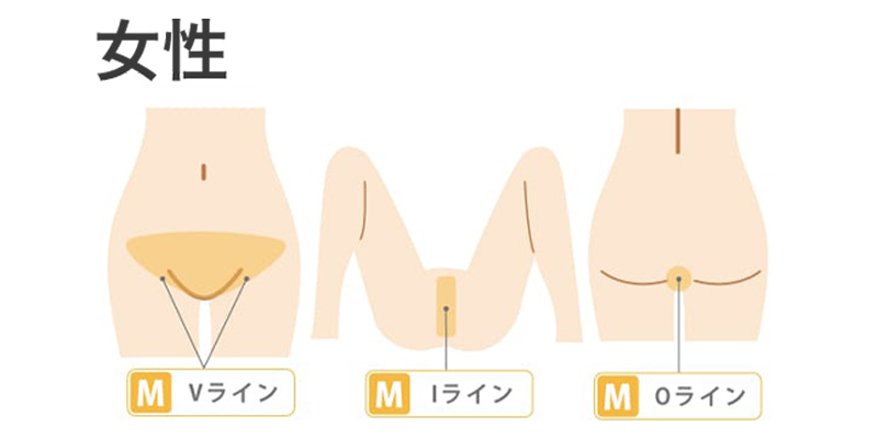 女性のVIO脱毛の部位を示すイメージ