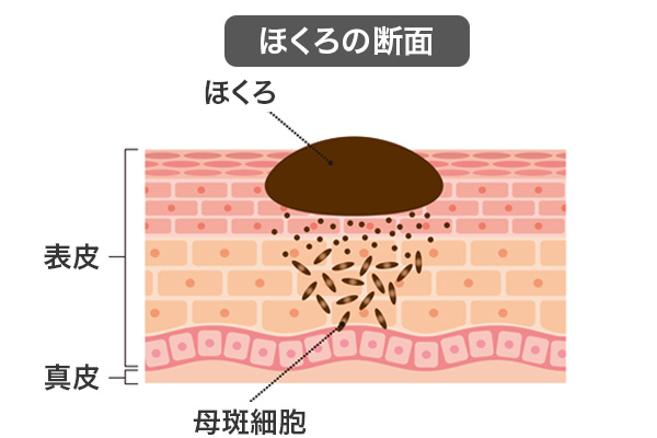 ほくろができる仕組み