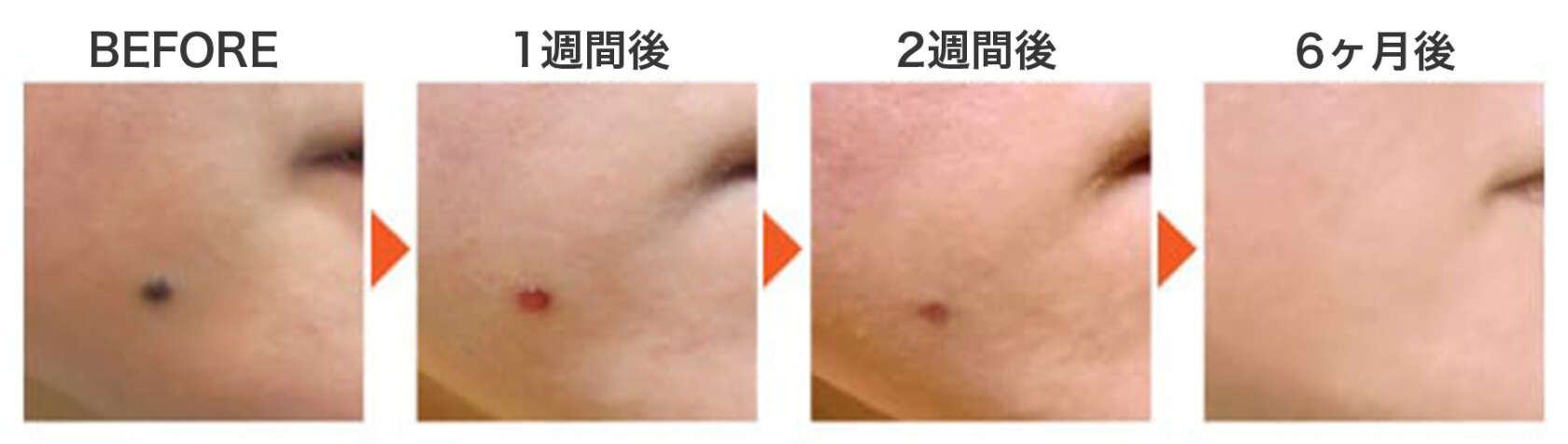 CO2レーザー施術のBeforeとAfter写真