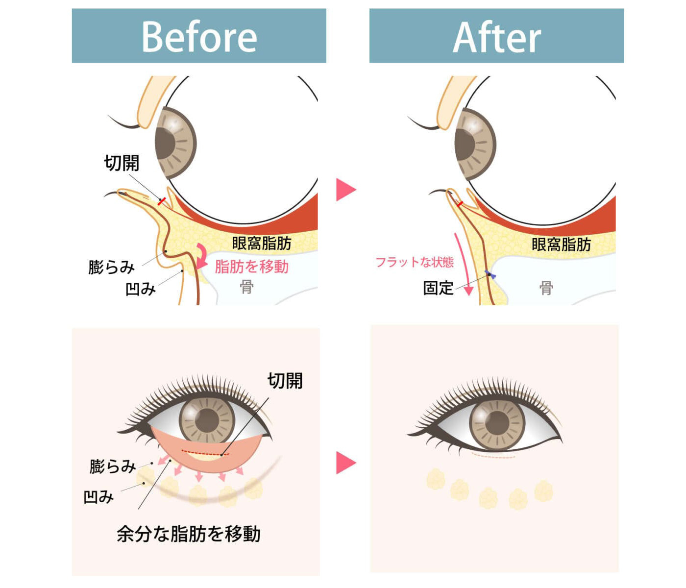 裏ハムラ法の施術イメージ