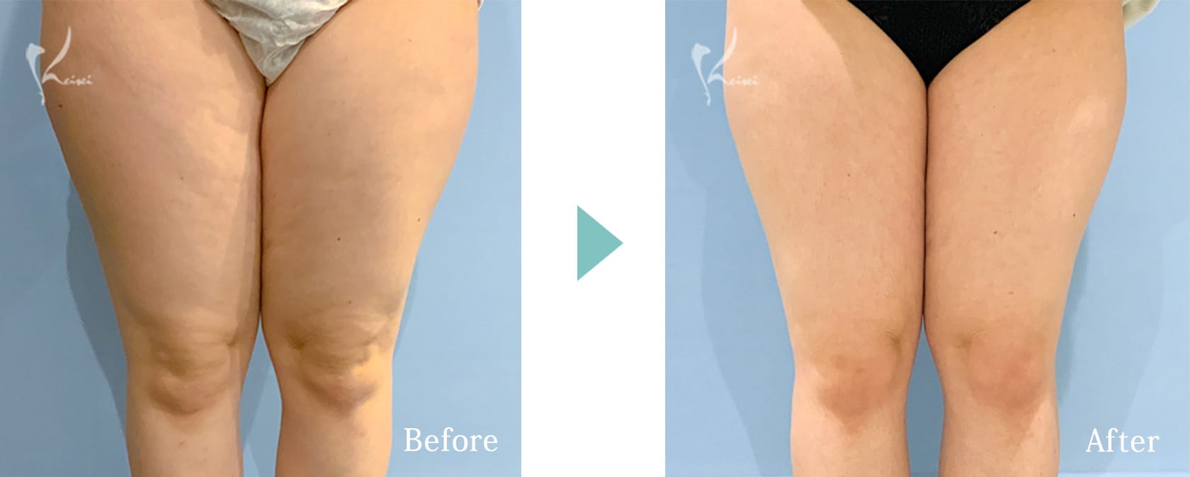 脂肪冷却のBeforeとAfter