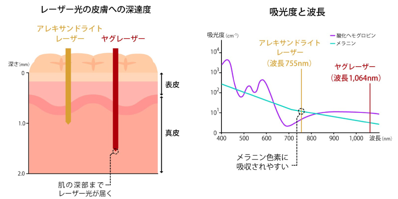 ジェントルマックスプロプラス搭載の2つのレーザー