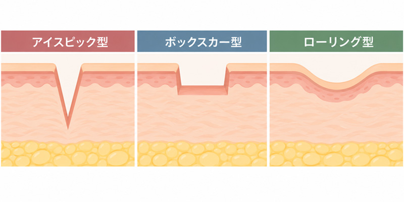 ニキビ跡のクレーターをアイスピック型・ボックスカー型・ローリング型に分類した図