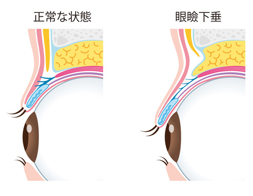 眼瞼下垂と上まぶたの皮膚のたるみの違い