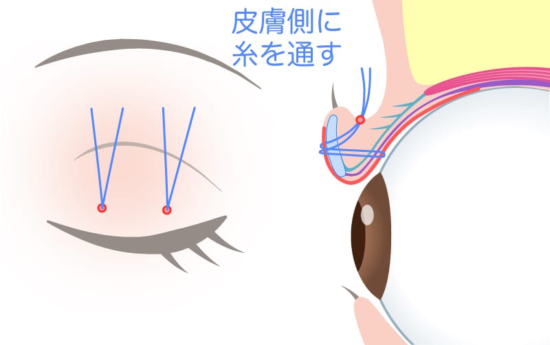 切らない眼瞼下垂の方法を表すイメージ