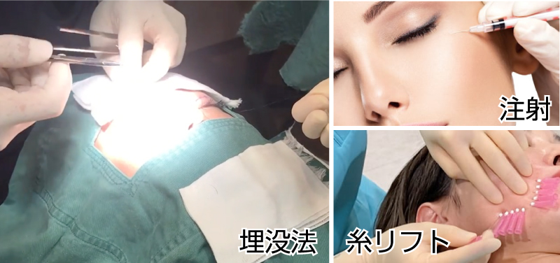 プチ整形イメージ