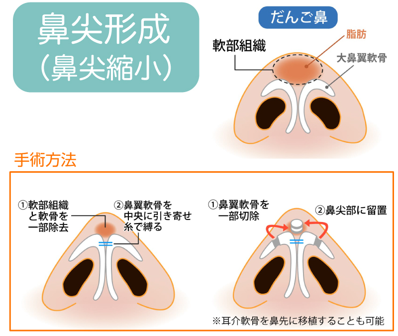 >鼻尖形成の主な手術方法