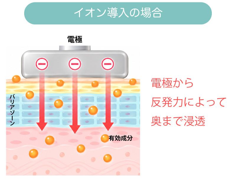 イオン導入の場合