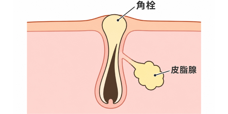 角栓がたまる