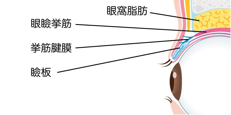 二重まぶたの仕組みを比較するイメージ