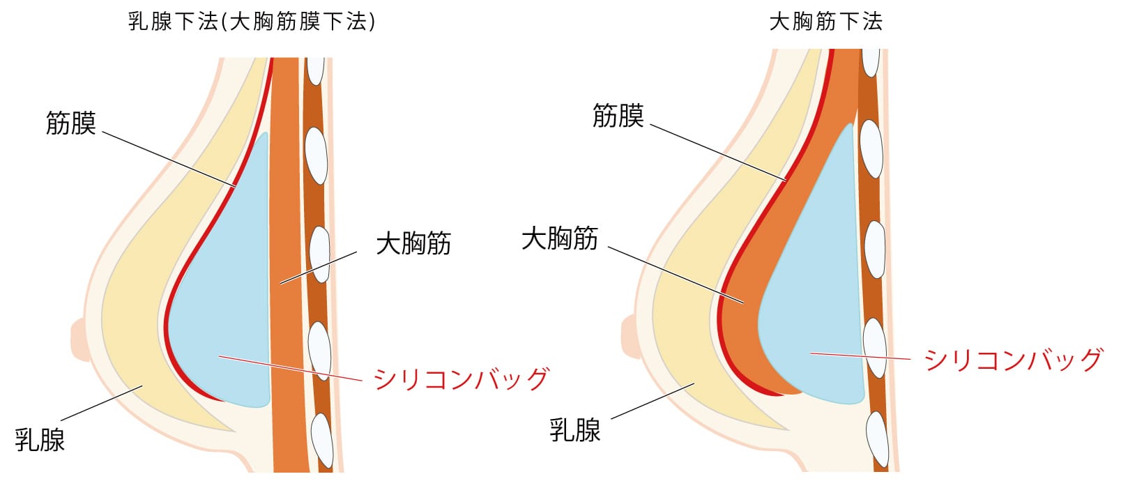 シリコンバッグ豊胸の仕組みと長期経過のイメージ