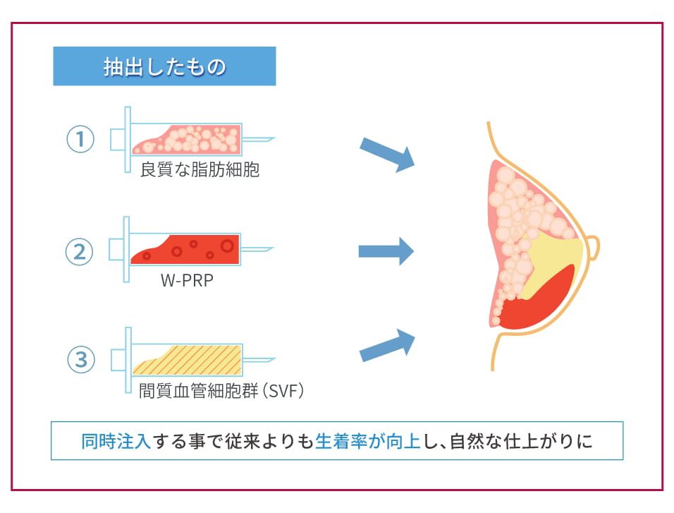 脂肪注入豊胸でバストに自身の脂肪を注入するイメージ