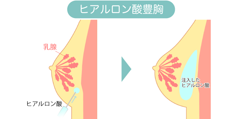 ヒアルロン酸注入による豊胸のイメージ