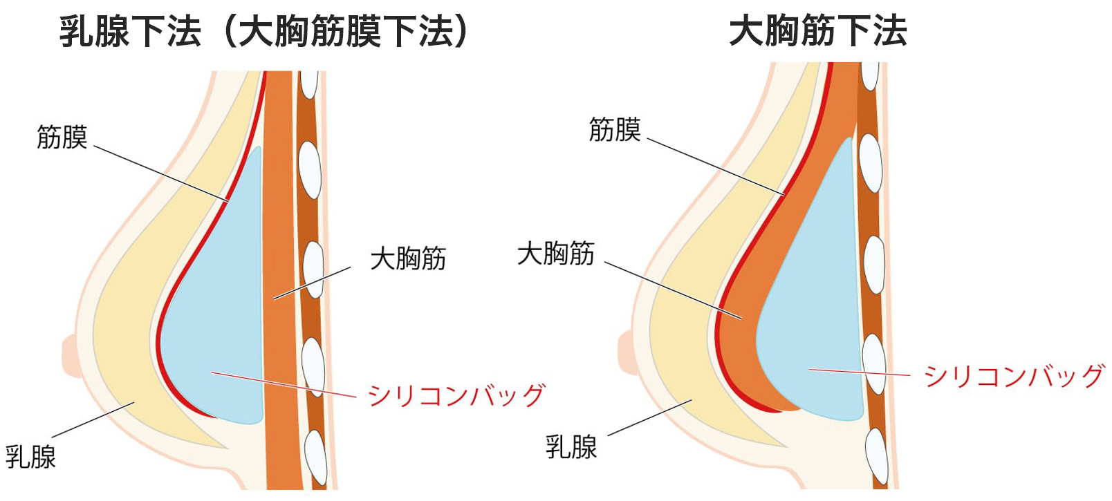 豊胸用シリコンバッグの挿入位置と乳腺下・大胸筋下の違い