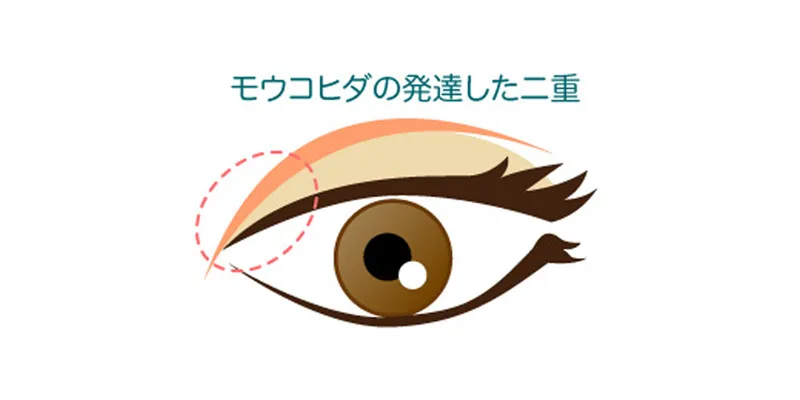 蒙古ひだと目頭切開の適応を説明する目元のイメージ