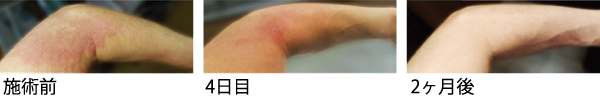 サイトカインブースター 臍帯血 再生因子 hscm100 再生医療 エイジングケア アンチエイジング 症例