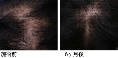 サイトカインブースター CytB-neo hscm100 臍帯血幹細胞 毛髪再生 発毛 育毛 ハゲ AGA 薄毛 症例