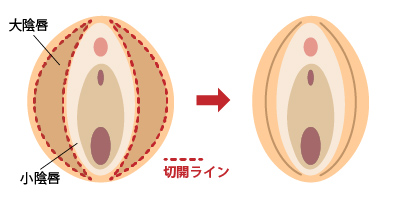 大陰唇縮小 女性器形成 大阪 女性特有の悩み