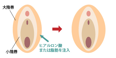 大陰唇増大 女性器形成 大阪 女性特有の悩み